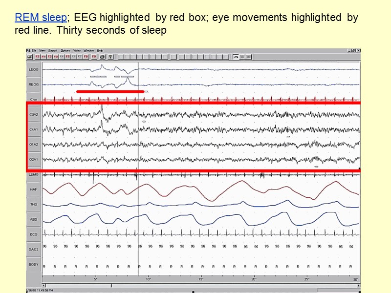 REM sleep; EEG highlighted by red box; eye movements highlighted by red line. Thirty